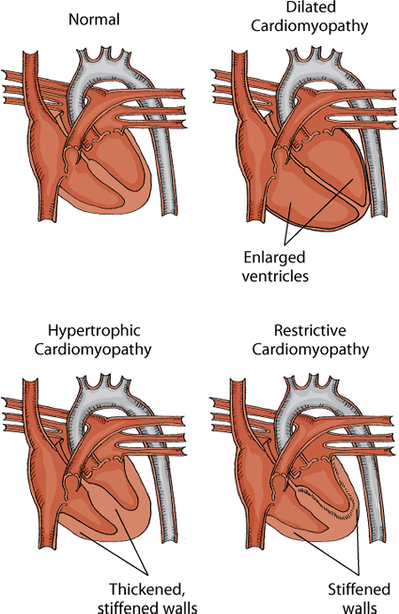 Types of cardiomyopathy in cats