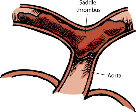 A thrombus (blood clot) can form as a complication of heart disease in cats. After dislodging from the heart, it can block blood flow in important arteries.