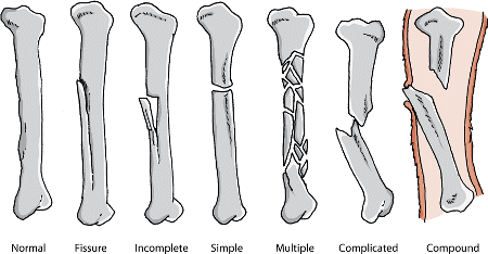 Fracture types can range from incomplete to compound.