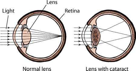 Normally, the lens receives light and focuses it on the retina. A cataract keeps some light from reaching the lens and distorts the light being focused on the retina.