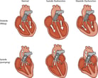 Heart Failure in Dogs