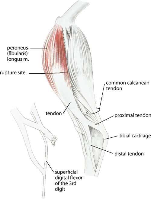 Rupture of the peroneus (fibularis) longus muscle in the turkey