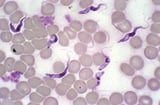 Tsetse-transmitted Trypanosomiasis